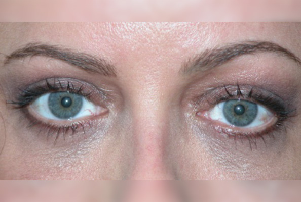 Blefaroplastia-estruturada